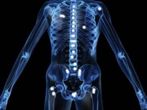 Метастазы в костях: симптомы, лечение, прогноз срока жизни