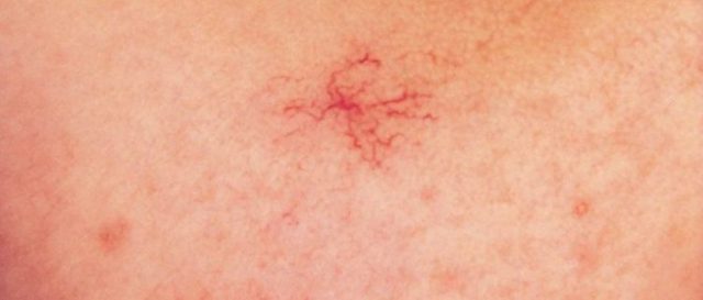 Гемангиома кожи: фото, причины возникновения, лечение и симптомы