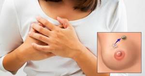 Кистозная мастопатия: лечение, симптомы, чем опасна, виды