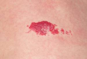 Гемангиома кожи: фото, причины возникновения, лечение и симптомы