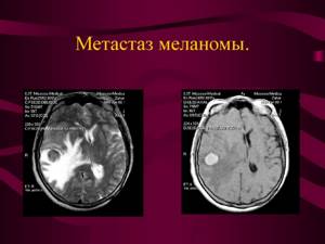 Метастазы меланомы: куда даёт, прогноз и лечение