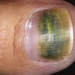 Гранулёма ногтя: лечение, фото, симптомы и причины