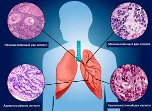 Плоскоклеточный рак лёгкого: стадии, прогноз, лечение и симптомы