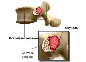 Остеобластома: симптомы и лечение на позвоночнике, челюсти, бедренной и других костях