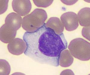 Атипичные лимфоциты: норма в анализе крови у взрослых и детей, причины повышения