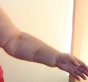 Лимфостаз руки после удаления молочной железы