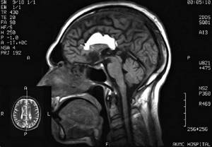 Липома головного мозга: лечение, симптомы и диагностика