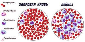 Острый миелобластный лейкоз: прогноз жизни, клинические рекомендации и анализ крови