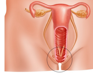 Рак уретры: симптомы, причины, лечение, диагностика и особенность протекания у мужчин и женщин