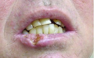 Рак губы: фото начальной стадии, симптомы, лечение и диагностика