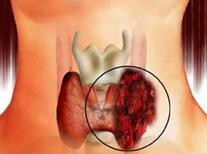 Папиллярный рак щитовидной железы: прогноз после операции, стадии и лечение