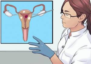 Миома матки в сочетании с эндометриозом: лечение и симптомы