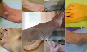 Гигрома стопы: лечение, фото, симптомы и удаление