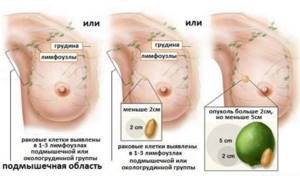 Рак груди 2 стадии Рак груди 2 стадии: прогноз выживаемости, лечение, симптомы и фото