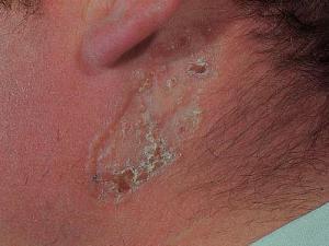 Базальноклеточный рак кожи: фото начальной стадии, лечение, прогноз и симптомы