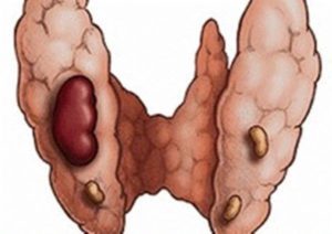 Фолликулярная аденома щитовидной железы: симптомы, лечение и операция