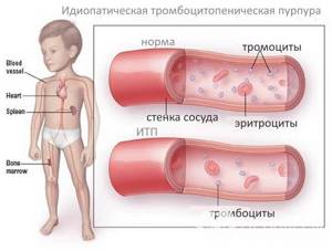 Тромбоцитопения: причины, лечение, симптомы, степени и клинические рекомендации взрослым и детям