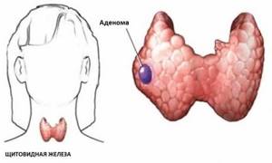 Аденома щитовидной железы: симптомы, нужна ли операция, лечение и прогноз жизни