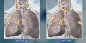 Немелкоклеточный рак лёгкого: симптомы, лечение, прогноз, 4 стадия