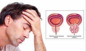 Аденома простаты у мужчин: симптомы, лечение, удаление и последствия