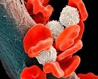 В-клеточная лимфома: виды, симптомы, прогноз, стадии и лечение