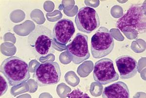 Моноцитарный лейкоз: симптомы, картина крови и прогноз жизни