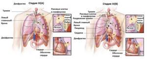 Рак лёгких 3 стадии: сколько живут, лечение и симптомы