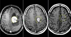 Лимфома головного мозга: симптомы, лечение и прогноз