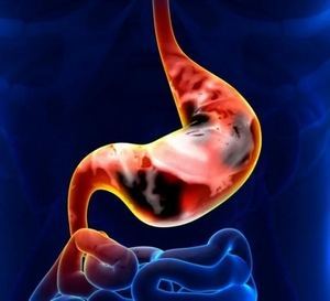 Рак пищевода: симптомы на ранних стадиях, лечение, причины, сколько живут и диагностика