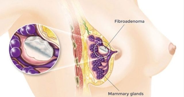 Можно ли вылечить фиброаденому молочной железы без операции