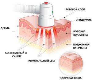 Фотодинамическая терапия: метод лечения в онкологии, косметологии и гинекологии, побочные эффекты