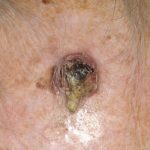 Плоскоклеточный рак кожи: фото начальной стадии, лечение, симптомы, прогноз и метастазы