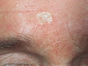 Базалиома на лице: фото разных стадий, симптомы и лечение
