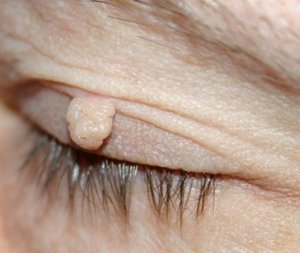 Фибропапиллома: симптомы, удаление на коже и десне, причины, лечение