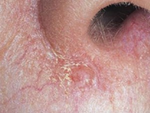 Базалиома на лице: фото разных стадий, симптомы и лечение