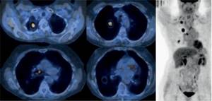 Немелкоклеточный рак лёгкого: симптомы, лечение, прогноз, 4 стадия