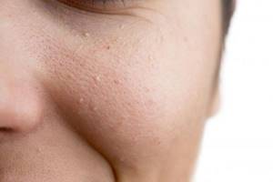 Жировики на лице: фото, причины, как быстро избавиться