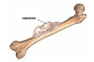 Саркома кости: симптомы, лечение, фото начальной стадии