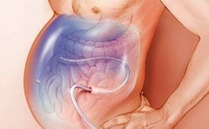 Асцит брюшной полости при онкологии: сколько живут, лечение и симптомы