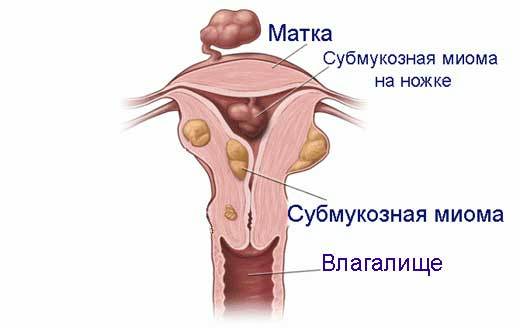 Субмукозная миома матки: размеры для операции, лечение и симптомы