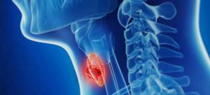 Опухоль щитовидной железы: симптомы доброкачественной и злокачественной