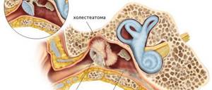 Холестеатома: симптомы, диагностика и операция по удаления при поражении уха, кости или мозга