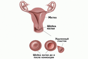 Рак шейки матки: причины, симптомы, признаки на ранних сроках, лечение и прогноз