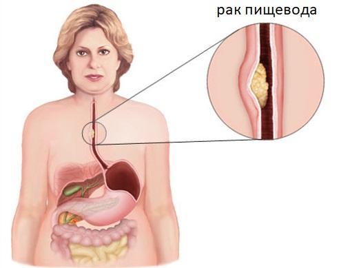 Рак пищевода: симптомы на ранних стадиях, лечение, причины, сколько живут и диагностика
