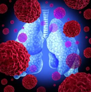 Рак лёгких 3 стадии: сколько живут, лечение и симптомы