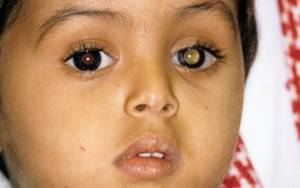 Ретинобластома: симптомы у детей, лечение глаза, причины