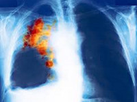 Мелкоклеточный рак лёгкого: стадии, лечение, прогноз, метастазы и первые симптомы