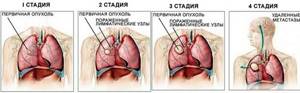 Опухоль лёгких: симптомы, виды, лечение, операция по удалению и стадии