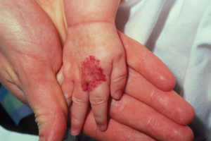 Гемангиома у детей: лечение, удаление, фото и причины возникновения