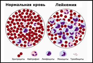 Гемобластозы: симптомы, диагностика, классификация и причины